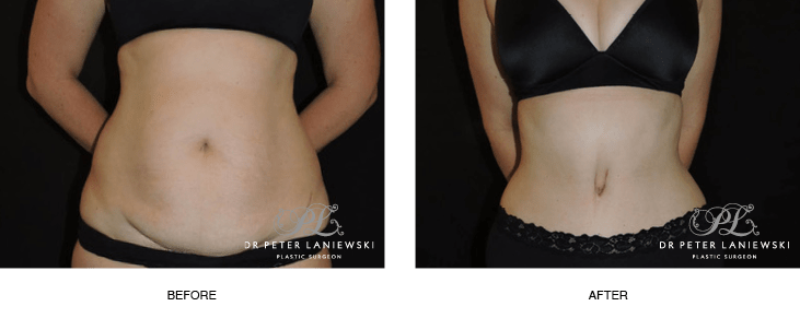 Steely Plastic Surgery - Before & After: Patient had a tummy tuck